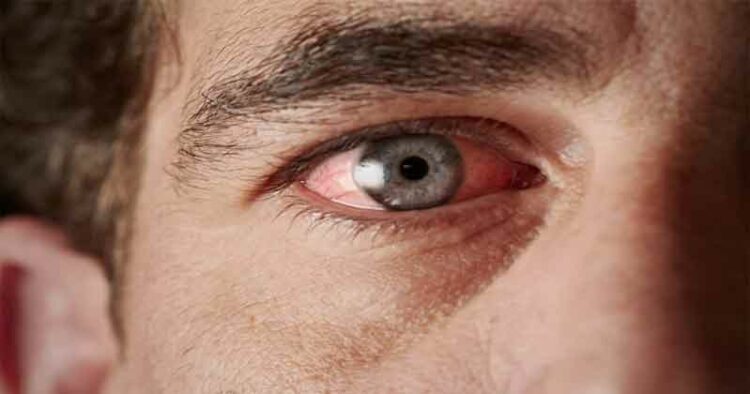 Diabetic Retinopathy