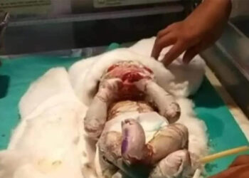 Plastic Baby: ಪ್ಲಾಸ್ಟಿಕ್ ಬೇಬಿ; ಬಿಹಾರದಲ್ಲಿ ವಿಚಿತ್ರ ಮಗುವಿನ ಜನನ,, ಮೈಮೇಲೆ ಚರ್ಮದ ಬದಲು ಪ್ಲಾಸ್ಟಿಕ್ ಇದ