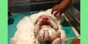 Plastic Baby: ಪ್ಲಾಸ್ಟಿಕ್ ಬೇಬಿ; ಬಿಹಾರದಲ್ಲಿ ವಿಚಿತ್ರ ಮಗುವಿನ ಜನನ,, ಮೈಮೇಲೆ ಚರ್ಮದ ಬದಲು ಪ್ಲಾಸ್ಟಿಕ್ ಇದ